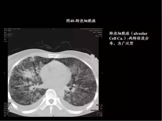 為什么做胸、腹部CT掃描時需要吸氣-屏氣-吐氣？