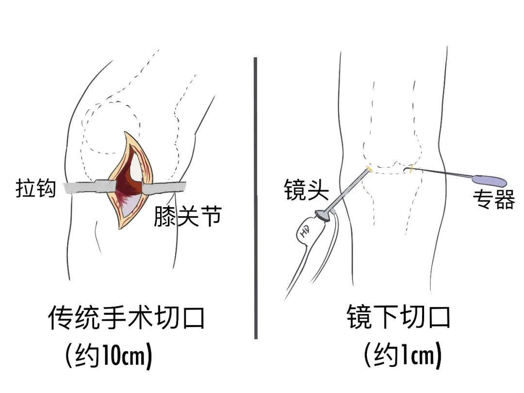 帶你一起認識關節鏡